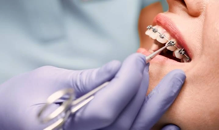Orthodontic treatment