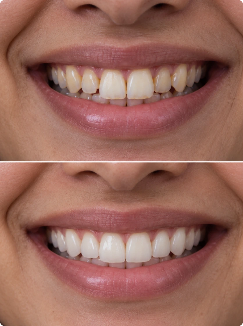 Smile makeover before and after