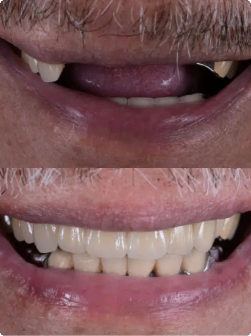Smile makeover before and after